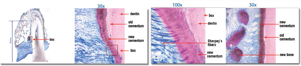 Photographic evidence of peridontal regeneration over a six-year span
